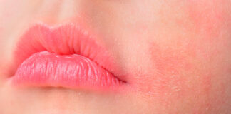Cera atopowa - kobieta z zaczerwienioną, wysuszoną skórą wokół ust